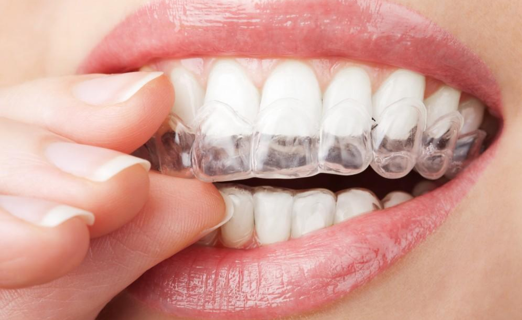 Woman removes invisalign