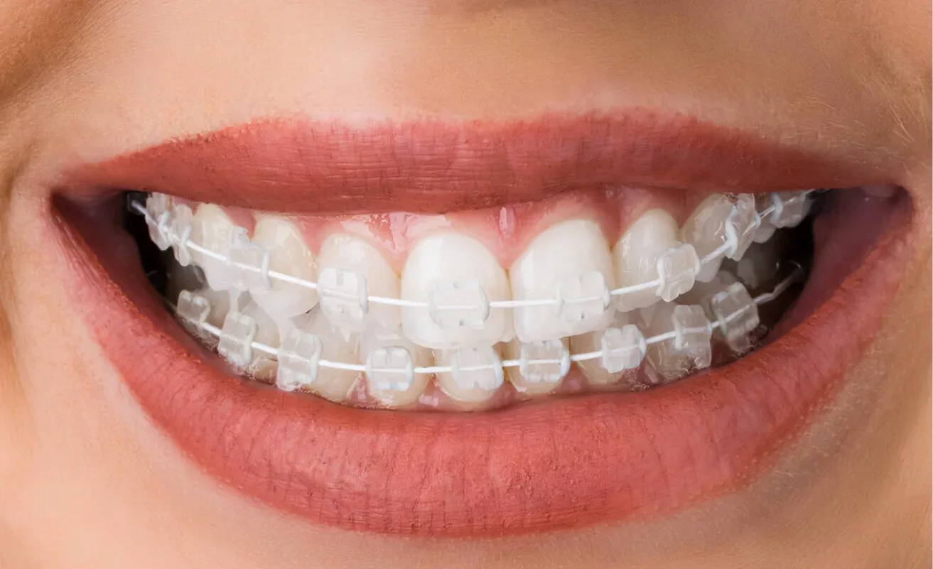 Smiling woman with braces