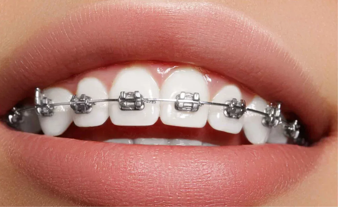 Smiling woman with braces